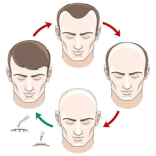 What Is the Recovery Time for Male Hair Transplantation?